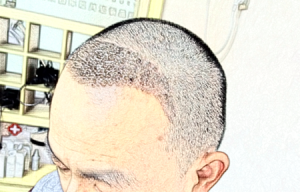 大連發(fā)際線種植費(fèi)用要多少?大連發(fā)際線種植醫(yī)院推薦