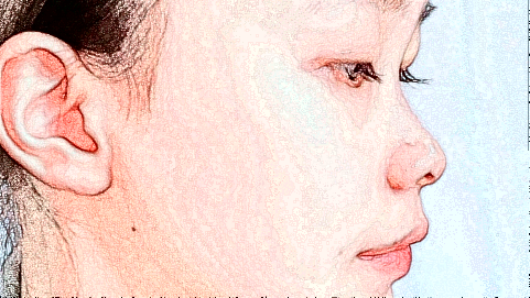 鼻翼縮小價(jià)格表_鼻翼縮小術(shù)后還會(huì)反彈嗎