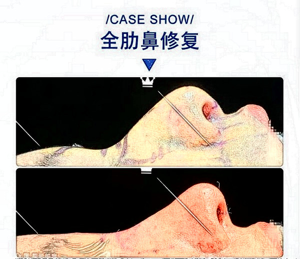 華西醫(yī)院卿勇全肋鼻修復(fù)案例圖片（來源知乎）