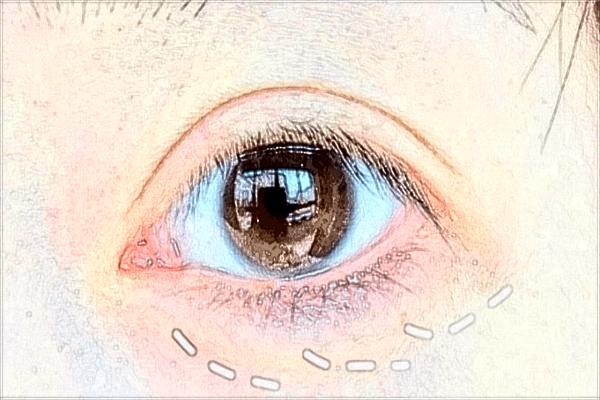 保定華美做雙眼皮哪個醫(yī)生好【附案例】