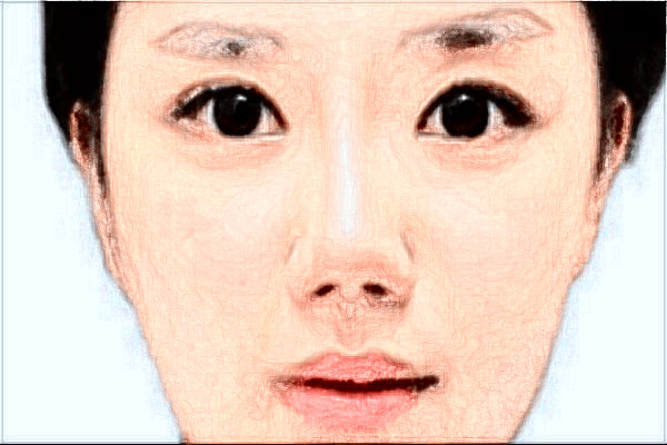 2024假體隆鼻價目表_假體隆鼻恢復(fù)期是多久