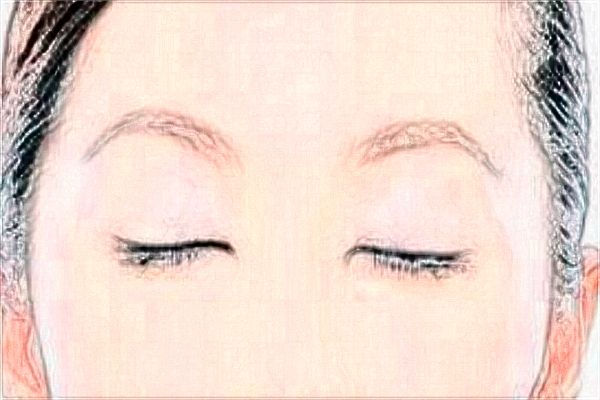 2024割雙眼皮價目表公布_割雙眼皮大概多久能恢復正常