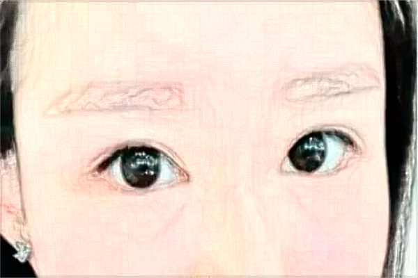 割雙眼皮會(huì)留疤痕不?割雙眼皮會(huì)導(dǎo)致視力下降嗎?