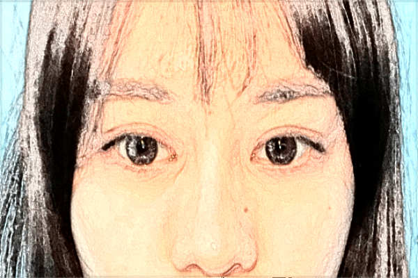 潮州哪里可以做雙眼皮?做的好嗎?