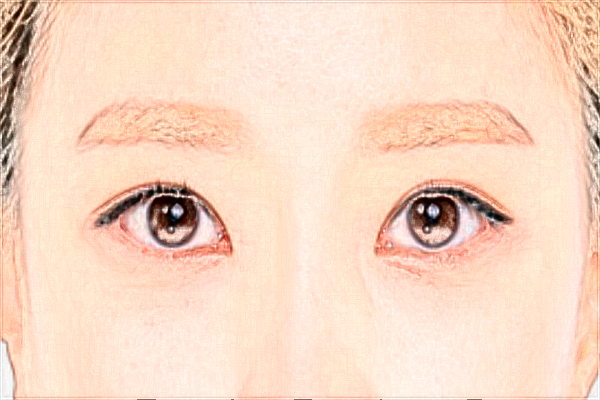 上海時光整形醫(yī)院做提眉怎么樣_提眉術和全切雙眼皮哪個效果好