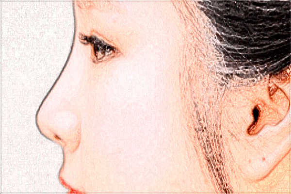 硅膠豐太陽(yáng)穴效果怎么樣?2024硅膠豐太陽(yáng)穴價(jià)格表