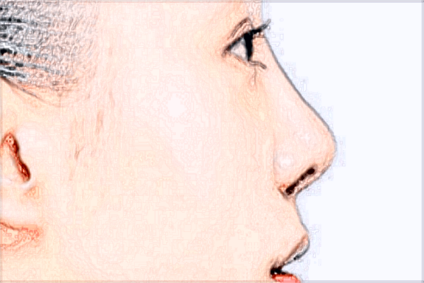 鄭大一附院祛疤醫(yī)生好不好?激光祛疤價格