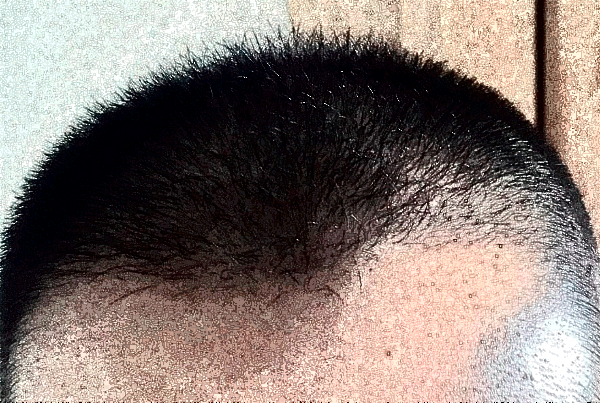 北京中醫(yī)醫(yī)院植發(fā)價目表(價格表)曝光_怎么樣