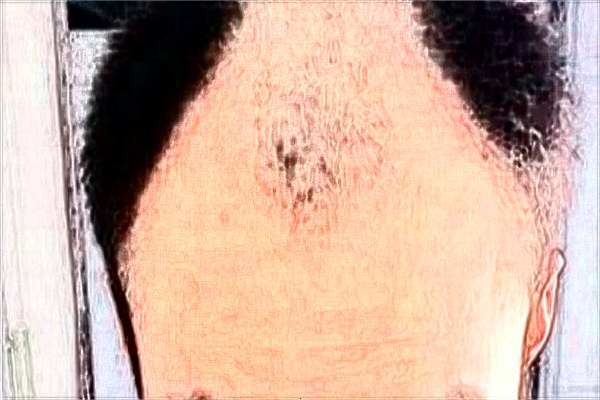 上海長征醫(yī)院種發(fā)際線收費(fèi)價(jià)格_種發(fā)際線怎么樣