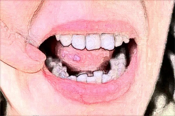 北京中醫(yī)醫(yī)院烤瓷牙補牙多少錢_哪位醫(yī)生技術(shù)比較好