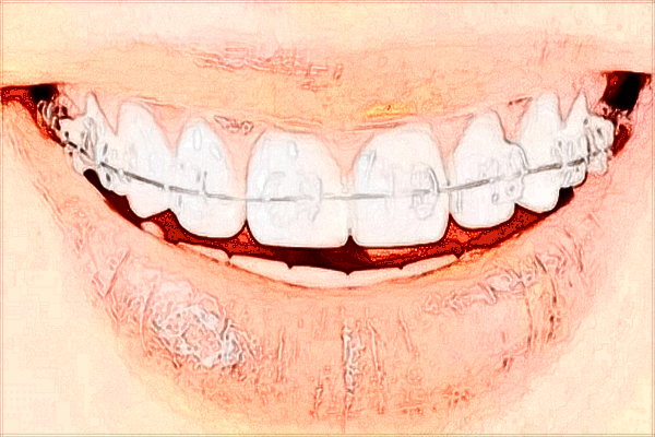 2024-2024齙牙矯正價(jià)目表公布_齙牙矯正的佳年齡是什么時(shí)候