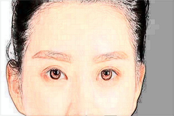 重慶聯(lián)合麗格去淚溝好不好_醫(yī)生名單