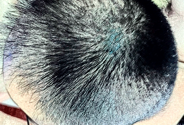 北京麗都植發(fā)怎么樣_醫(yī)生名單