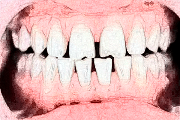 2024牙齒缺損修復(fù)價(jià)目表_牙齒缺損修復(fù)方法有哪些