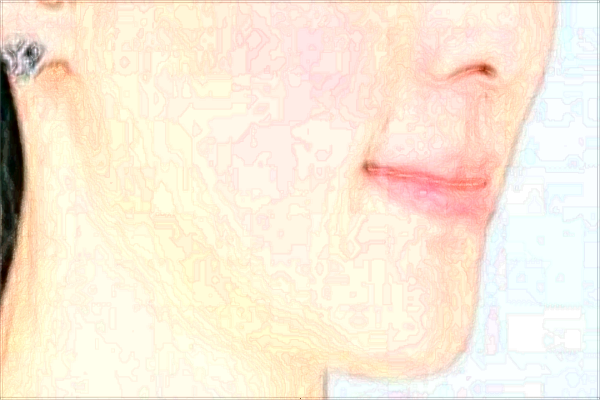 交大二院墊下巴怎么樣【附墊下巴案例】