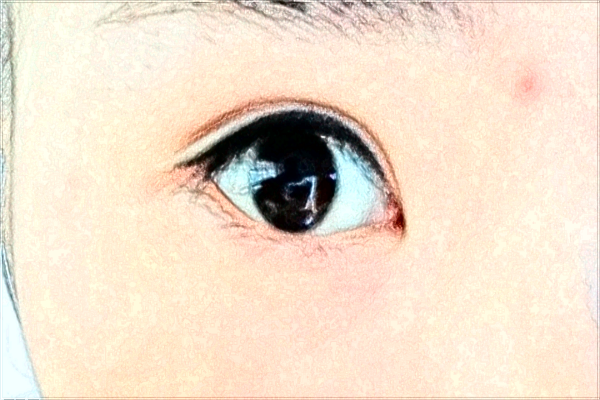 北京麗都開眼角哪個醫(yī)生好【開眼角案例】