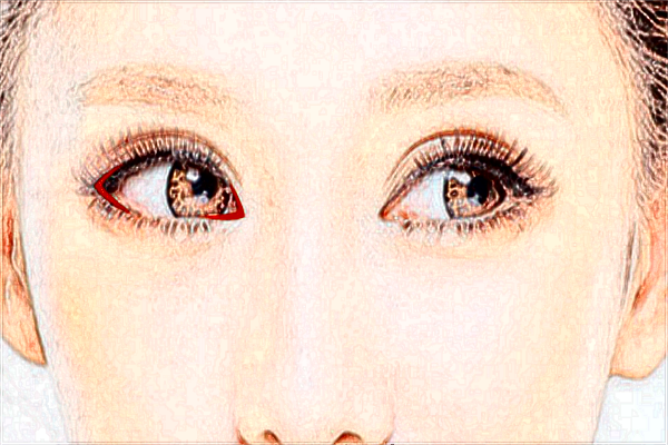 北京麗都開眼角哪個醫(yī)生好【開眼角案例】