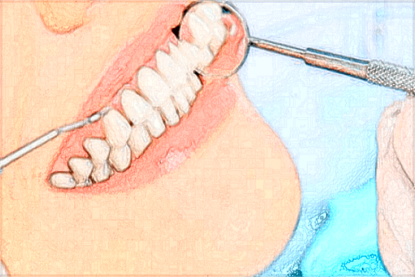 植牙多少錢(qián)一顆2024_植牙的利弊是什么
