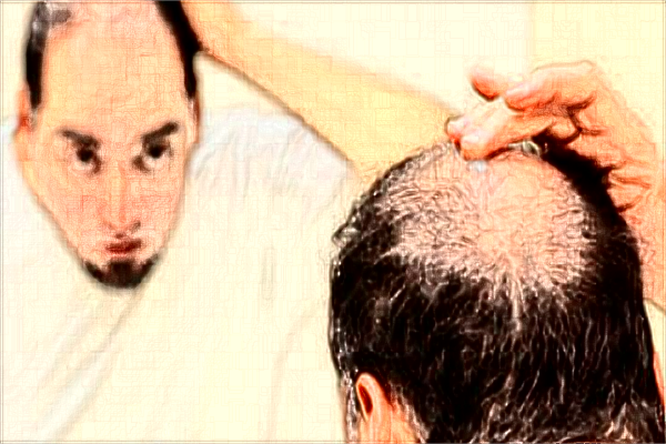 種植發(fā)際線一般多少錢?種植發(fā)際線多久能長(zhǎng)起來(lái)