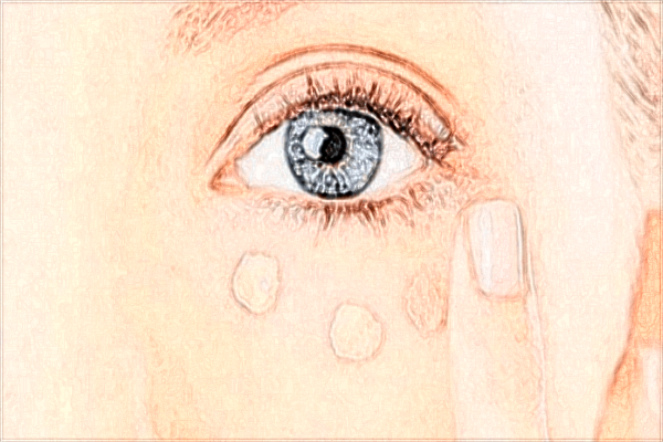 北京二院去眼袋怎么樣?2024去眼袋收費(fèi)價(jià)格