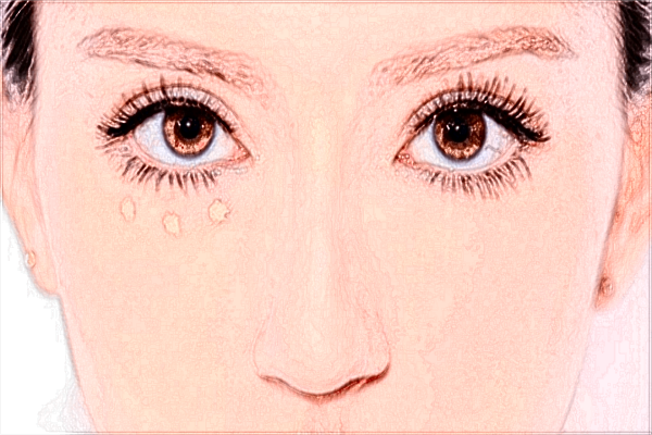 北京二院去法令紋怎么樣?2024去法令紋價格