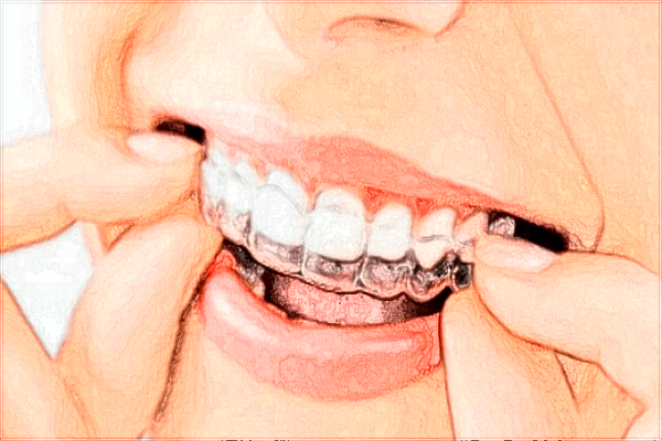 北京大學口腔醫(yī)院種植牙價格表_種植牙需要住院嗎