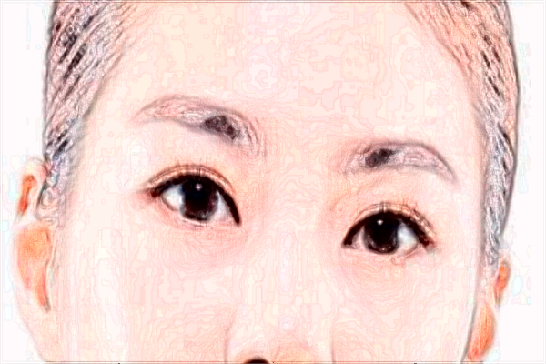 2024交大二院打玻尿酸好不好【附玻尿酸案例】