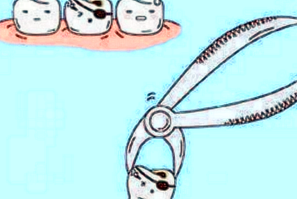 2024北京地壇醫(yī)院口腔科拔牙怎么樣_拔牙后的注意事項(xiàng)