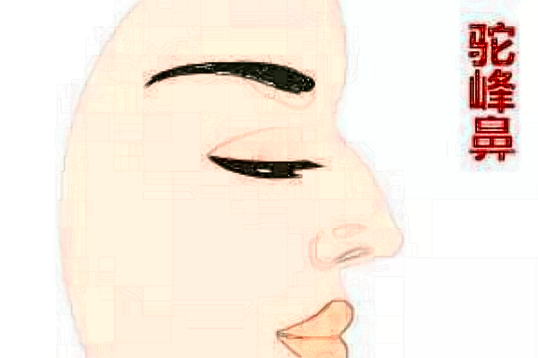 成都華西醫(yī)院隆鼻假體取出多少錢_隆鼻假體取出后多久可以恢復(fù)