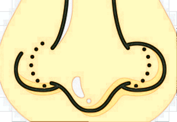 膨體隆鼻會(huì)透光嗎?膨體隆鼻會(huì)膨體下滑嗎?