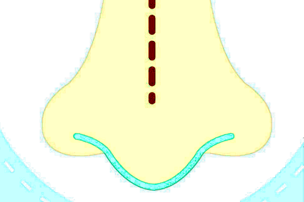 膨體隆鼻要多長時(shí)間?膨體隆鼻要住院嗎?