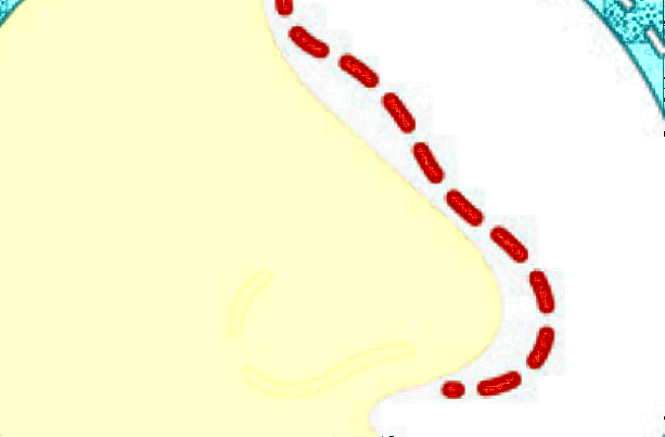 膨體隆鼻多少費(fèi)用?膨體隆鼻要忌口多長(zhǎng)時(shí)間?