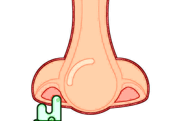 膨體隆鼻需要耳軟骨嗎?膨體隆鼻需要開(kāi)刀嗎?