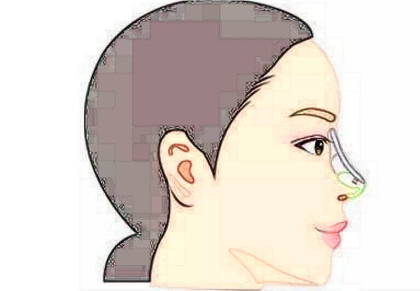 膨體隆鼻多久消腫?膨體隆鼻多久可以拆線?