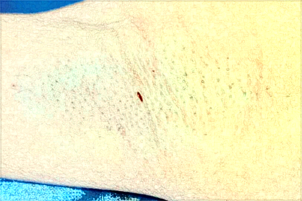 南京市中醫(yī)院激光狐臭做的好嗎？需要多少錢