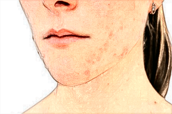 福州總醫(yī)院激光祛斑怎么樣?2024激光祛斑收費(fèi)價(jià)格