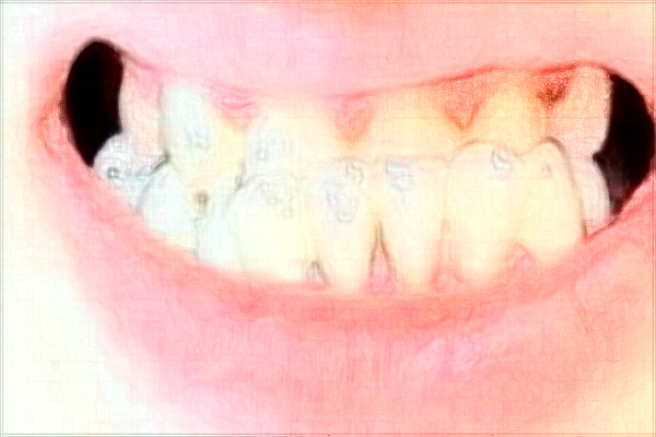 廈門市第—醫(yī)院牙科種植牙找哪個(gè)醫(yī)生?2024收費(fèi)價(jià)格