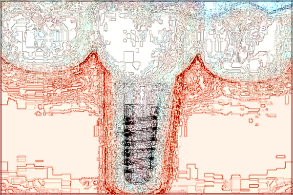 北大口腔醫(yī)院隱形口腔正畸價格表_案例