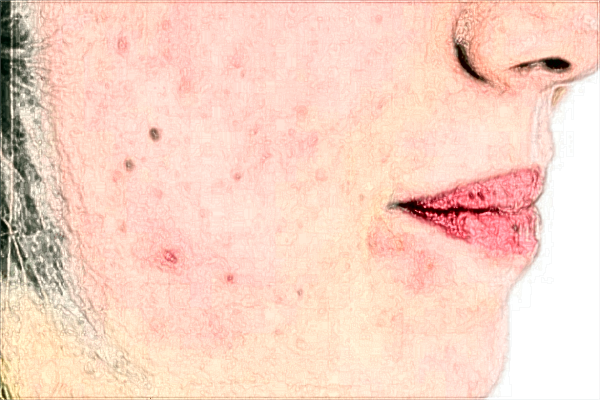 河科大二附院祛痘印怎么樣?去痘印新價(jià)格2024