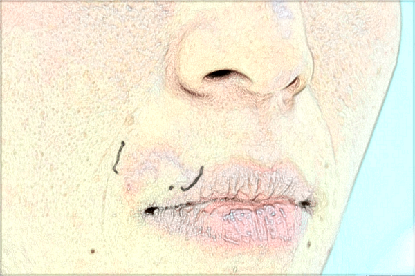 河科大二附院祛痘印怎么樣?去痘印新價(jià)格2024