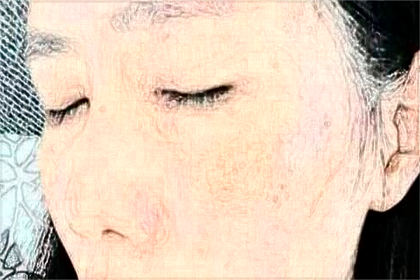 河科大二附院激光祛斑好嗎?激光祛斑手術(shù)案例