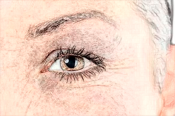 浙江省中醫(yī)院激光去黑眼圈好嗎?去黑眼圈會(huì)不會(huì)反彈