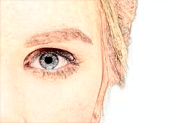 2024浙江省中醫(yī)院做眼袋醫(yī)生技術怎么樣【做眼袋案例】