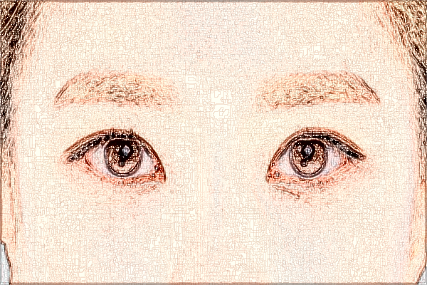 2024浙江省中醫(yī)院做眼袋醫(yī)生技術怎么樣【做眼袋案例】