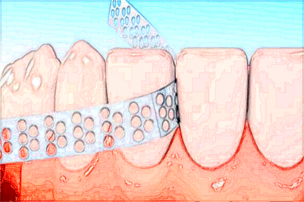2024成都華西醫(yī)院牙科補(bǔ)牙多少錢_補(bǔ)牙需要多長(zhǎng)時(shí)間才能補(bǔ)好