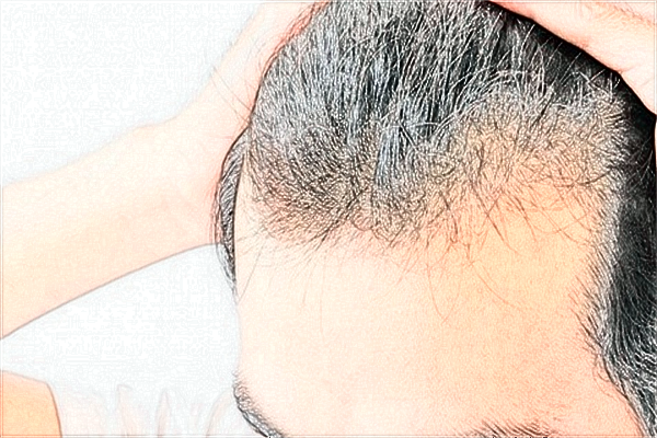 2024西安二院植發(fā)多少錢?植發(fā)后還會(huì)脫落嗎