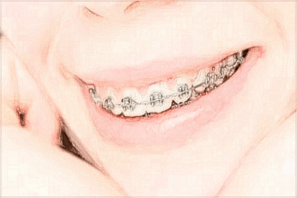 溫州醫(yī)學(xué)院附屬第一醫(yī)院牙齒矯正怎么樣_案例+價格