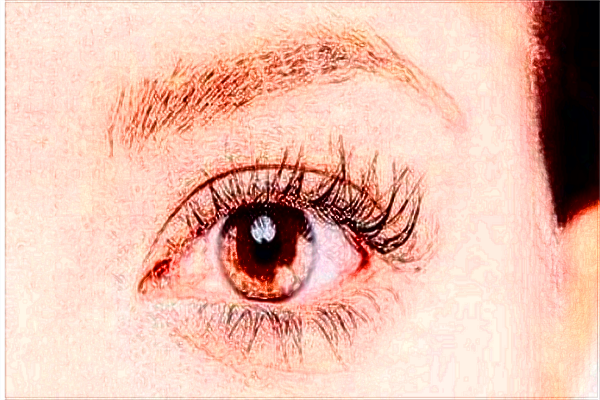 2024廣州華美去眼袋手術(shù)一般多少錢【去眼袋案例】