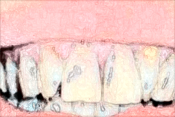 南昌大學(xué)第二附屬醫(yī)院矯正牙齒怎么樣?2024矯正牙齒的費(fèi)用