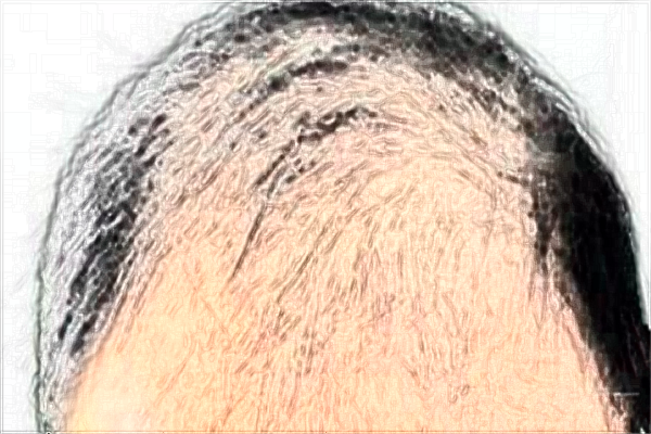 南昌大學第一附屬醫(yī)院種植頭發(fā)怎么樣?2024植發(fā)價格